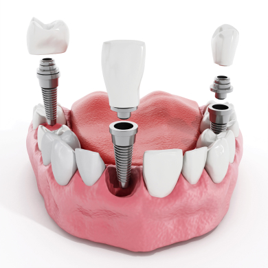 Implantes dentários
