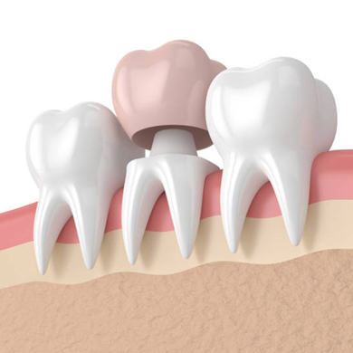 Coroa dentária